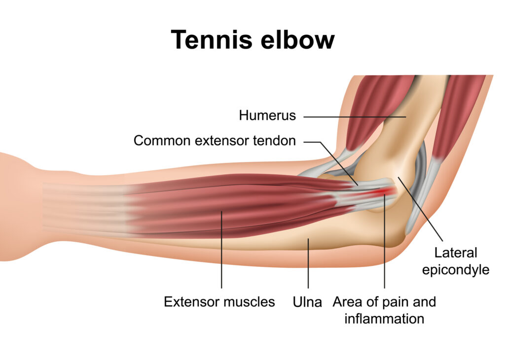 Elbow Tendonitis